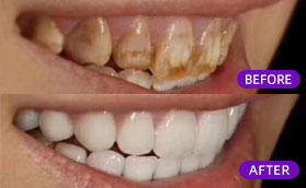 上海美奥口腔医院E-MAX牙齿全瓷贴面对比照片