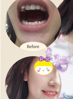 牙齿矫正前后对比