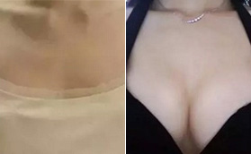 在海南韩美医学美容医院做了假体隆胸手术，还有案例对比
