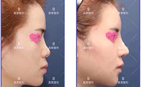 恩施奥莱整形医院假体隆鼻手术前后案例对比照片