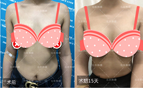 人工韧带乳房上提术真人案例明白北京韩啸几十万价格原因