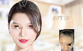 广州仁健医疗美容门诊部女士植发案例过程对比照