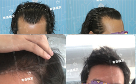 广州青逸医疗美容门诊部男士植发案例前后对比照