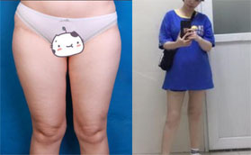 7个月恢复经历证明我在深圳美莱做大腿吸脂没有反弹