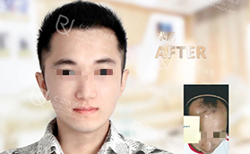 广州仁健医疗美容门诊部男士植发案例过程对比照