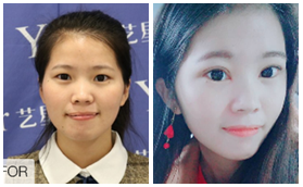 南京艺星刘永扬美杜莎综合美眼术前后效果对比图