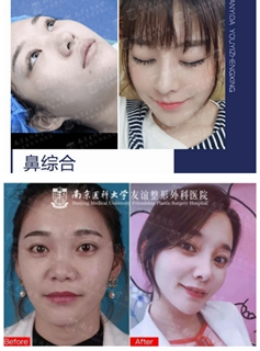南京医科大学友谊整形外科医院鼻部整形案例
