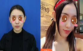 北京艺星连凯峰隆鼻效果如何？花费八千做假体隆鼻恢复图