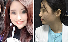广州联合丽格医疗美容光子嫩肤色斑治疗案例合集