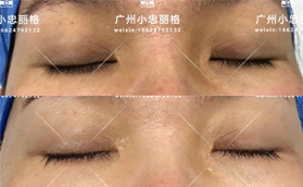 广州联合丽格医疗美容黑眼圈眼周细纹治疗案例合集