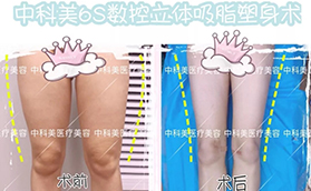 广州中科美医疗美容医院手臂大腿吸脂案例合集