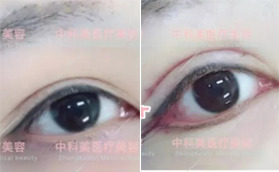 广州中科美医疗美容医院双眼皮手术案例合集