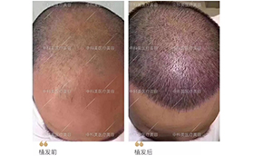 广州中科美医疗美容医院男士毛发移植案例对比