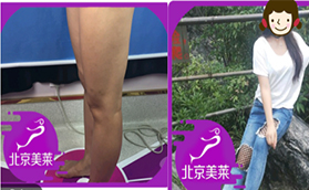 北京美莱吸脂多少钱？大腿吸脂真人案例给你参考答案