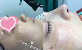 广州佳人医疗美容门诊部耳软骨鼻综合案例对比