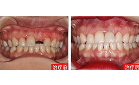 三亚口腔医院李力牙齿种植案例