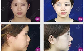 广州韩妃整形膨体鼻中隔耳软骨隆鼻手术案例对比