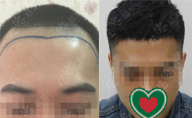 广州植德植发医院自体毛发移植男士发际种植案例