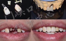 三门峡口腔来科普瑞士ITI种植牙技术优势及适应症有哪些？
