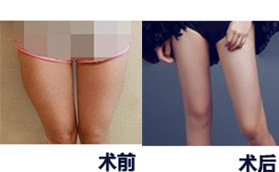 长沙雅美医疗美容医院大腿吸脂案例对比图