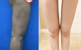 大腿吸脂凹陷修复成功，分享我在深圳仁安雅做手术的照片