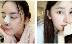南京鼻祖医疗美容王刚做自体耳软骨隆鼻案例对比图分享