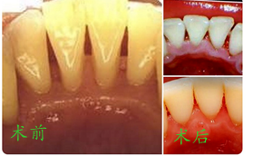 牙结石很严重的我，在南京雅度口腔做超声波洗牙过程分享