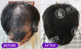 为改善脱发秃顶我去上海新生做头发种植拿到一份植发价格