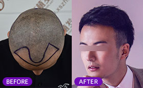 我去上海新生做了植发手术，8个月让我告别了m型发际线
