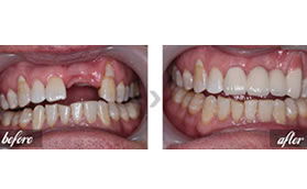 保定雄县新一代口腔种植牙前后对比案例