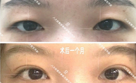 北京八大处双眼皮效果怎么样？眼部整形案例及价格表分享