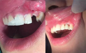 巴中白玉牙科真人案例让你直观感受种植牙哪个步骤较痛苦