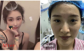 南京河西美容医院宿培龙硅胶隆鼻修复案例分享