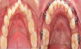 在许昌赛尔口腔做金属自锁矫正牙齿4个月效果照片展示