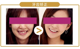 韩国女孩在沈阳完佩口腔做牙齿矫正后脸变小了肿么肥事？