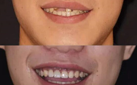单颗牙缺失在常州美奥口腔做种植牙，历时6月恢复灿烂笑容