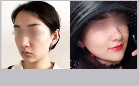上海诺诗雅自体肋软骨隆鼻脂肪填充对比照片